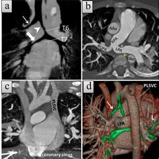 A Month Old Girl With Type B Left Pulmonary Artery Sling Lpas With