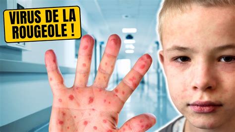 Une Croissance Inqui Tante Des Infections De Rougeole En Europe