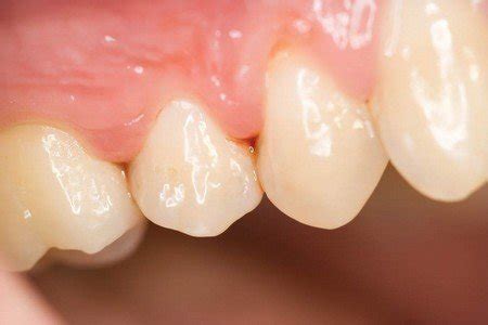 Gingivitis Causes, Treating and Preventing