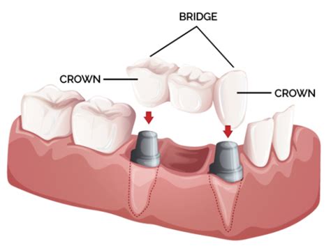 Crown and Bridge - Hill Park Dental