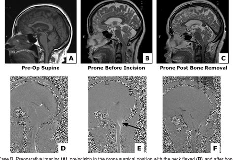 Figure 1 From Changes In Cerebrospinal Fluid Flow Assessed Using