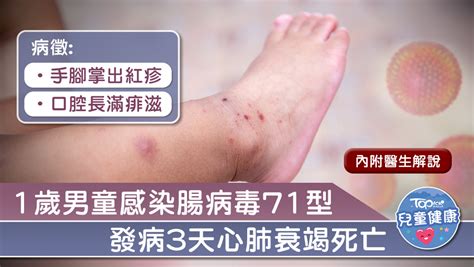 【兒童健康】1歲男童感染腸病毒71型3天內死亡 醫生：學童是感染高危人士