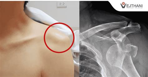 Recurrent Shoulder Dislocation Is Treatable