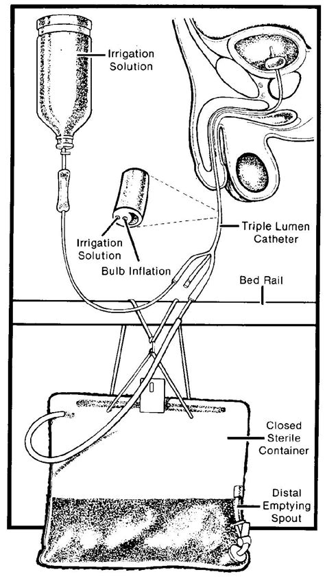 Foley Catheter Female Insertion At Nadine Wilkins Blog