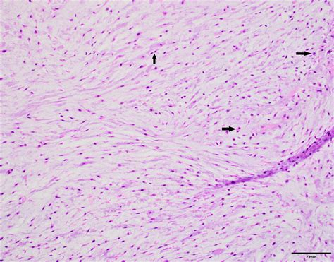 Osteochondroma Histology