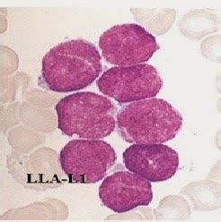 Fichero de hematología Células sanguíneas Leucemia linfoide aguda