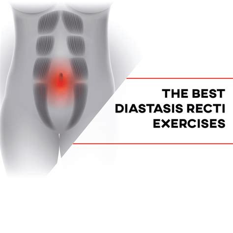 Diastasis Recti Abdominis Exercises P Rehab