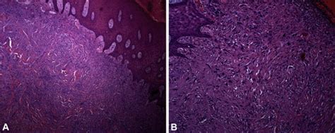 Histopathologic Features Of Scc A Punch Biopsy From The Scalp Shows A