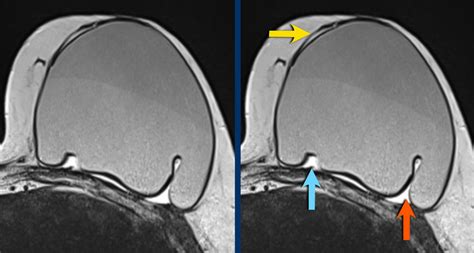 The Radiology Assistant Breast Implants