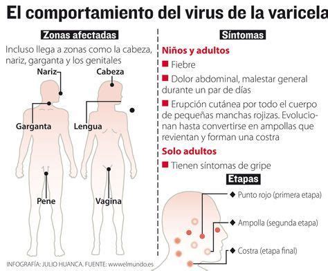 varicela2 Varicela Dolor abdominal Enseñanza biología