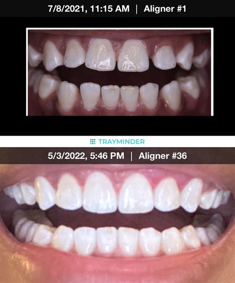 ADVICE: Wear your retainers 22/7 for the first few months, at least