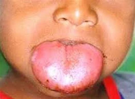 Macroglossia Causes Signs Symptoms Diagnosis Macroglossia Treatment