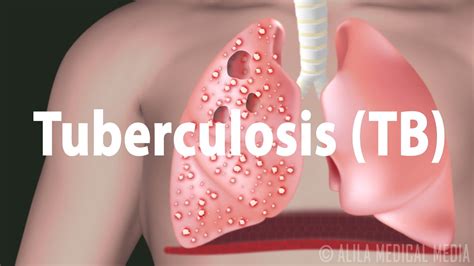 Tuberculosis Tb Progression Of The Disease Latent And Active