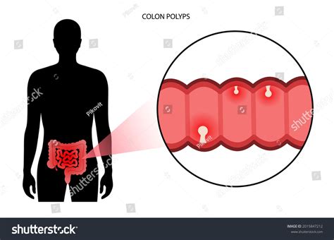 Colon Polyps Concept Hyperplastic Inflammatory Hamartomatous Stock Vector (Royalty Free ...