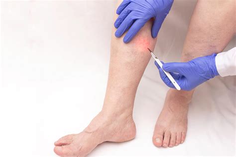 Ambulatory Phlebectomy Varicose Vein Treatment Vein Doctors Sydney