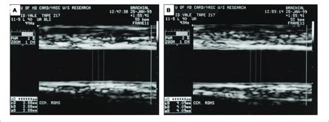 Ultrasound Images Demonstrating Brachial Flow Mediated Dilatation