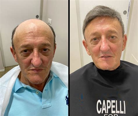 Protesi Per Capelli Calvizie Alopecia Evolution Planet