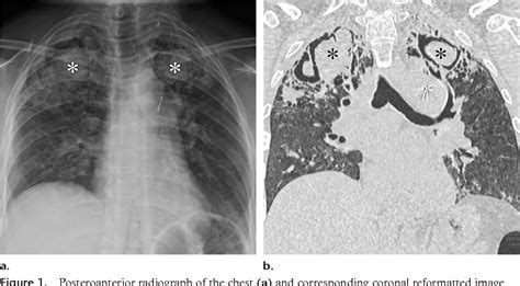 Figure 1 From Airp Best Cases In Radiologic Pathologic Correlation Pulmonary Sarcoidosis