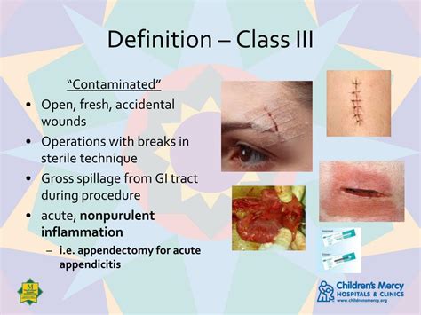 Ppt Wound Classification Powerpoint Presentation Free Download Id