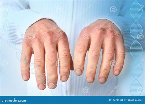 Close Up Of Male Hands With Dry Skin Damage Dermatology Medical