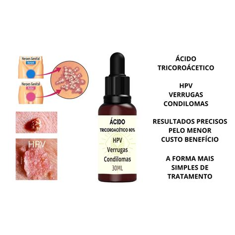 Removedor verruga hpv Acido Tricloroacético Tca Ata 90 30ml