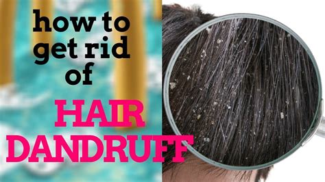 Hair Dandruff I How To Get Rid Of Dandruff Healthy Lifestyle Official