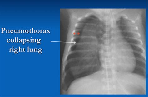 Anat Radiology Pneumothoarx Diffuse Lung Disease Flashcards