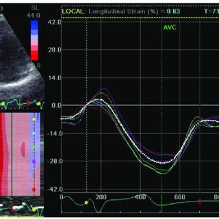 Right Ventricular Peak Systolic Longitudinal Strain Of Group A