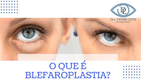 O que é Blefaroplastia e como realizar a cirurgia