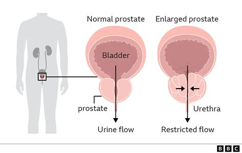 Enlarged Prostate What Is It And How To Treat It