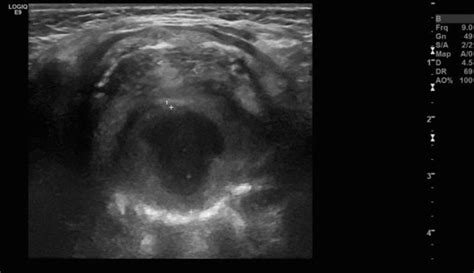 Acute Presentation Of An Intraoral Dermoid Cyst Causing Airway