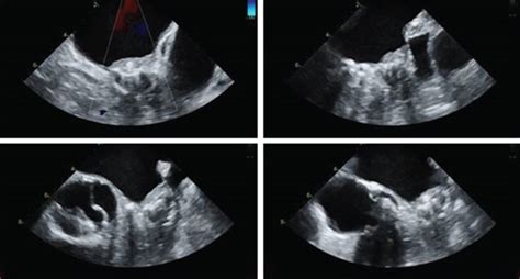 16 Hours Postoperative Tee Showing Thrombus On A Watchman Device