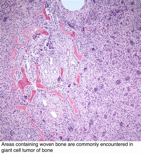 Pathology Outlines Giant Cell Tumor Of Bone