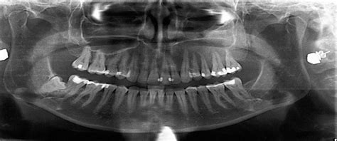 Central Cemento Ossifying Fibroma Primary Odontogenic Or Osseous