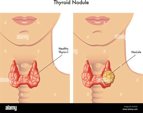 medical illustration of the symptoms of thyroid nodule Stock Vector ...