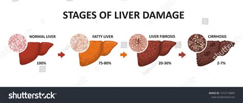 Stages Liver Damage Healthy Fatty Liver Stock Illustration 1312710800