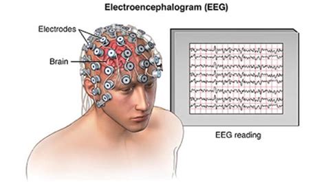 Epilepsy: Symptoms, Causes, Diagnosis, Treatment, and More