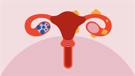 What’s The Difference Between Endometriosis and PCOS?