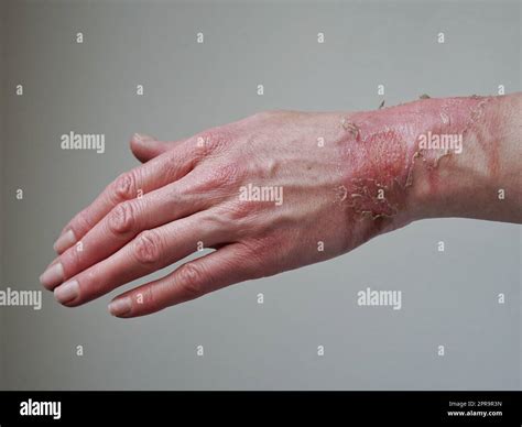 Close Up Of A Womans Hand With A Burst Blister From A Boiled Water