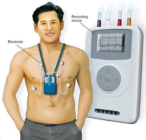 Remote Monitoring Of Cardiac Devices