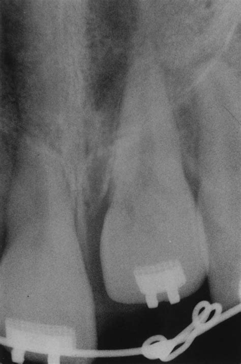 Treatment Of An Ankylosed Central Incisor By Single Tooth Dento Osseous Osteotomy American