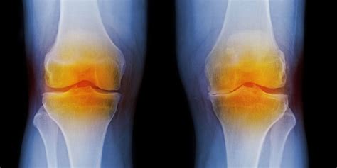 What Is Osteoarthritis Causes Treatment And Symptoms