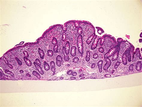 2 Duodenal biopsy from a child with celiac disease, showing the typical... | Download Scientific ...