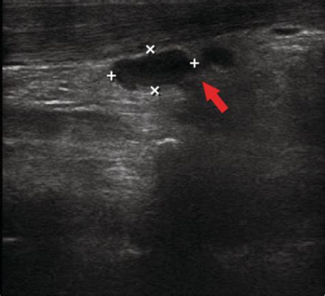 Right Submandibular Lymph Node With Mild Inflammatory Changes