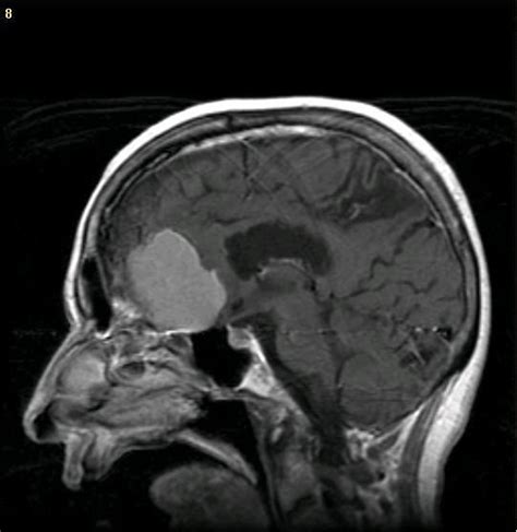 Brain Tumors Whos Had Them What The Symptoms Are And What The X Rays Look Like Video