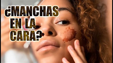 Tratamientos Naturales Para Eliminar Las Manchas Ana Rojas Youtube