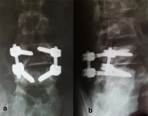 Postoperative Antero Posterior A And Lateral B Radiographs Of The