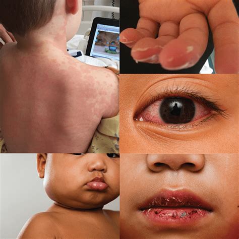 Kawasaki Disease Signs Symptoms And Diagnosis American Heart