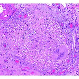 A Nonnecrotizing Epithelioid Granulomas In The Ileum Subserosa B