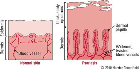 Psoriasis: greater than skin deep - Health Fit Ideas